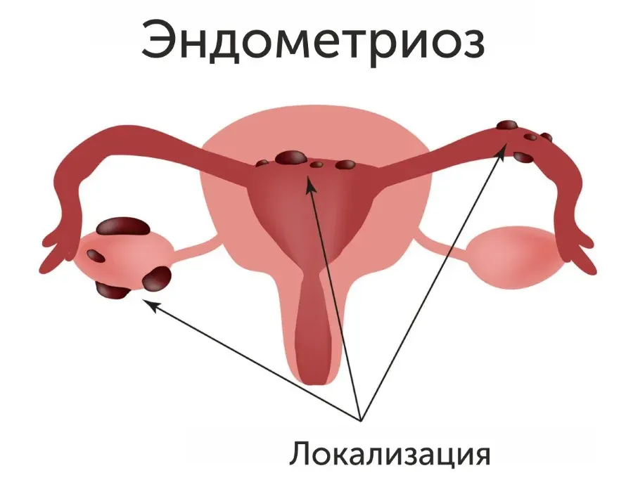 Эндометриоз - диагностика и лечение, причины, симптомы | Клиника «Геном» в Ростове-на-Дону